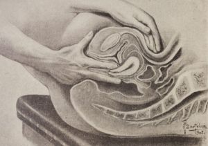 Tacto combinado vaginal rectal. Siglo XIX