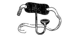 Histeroforo de James