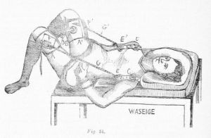 Colocación quirúrgica ginecologica. Siglo XIX. Grabado