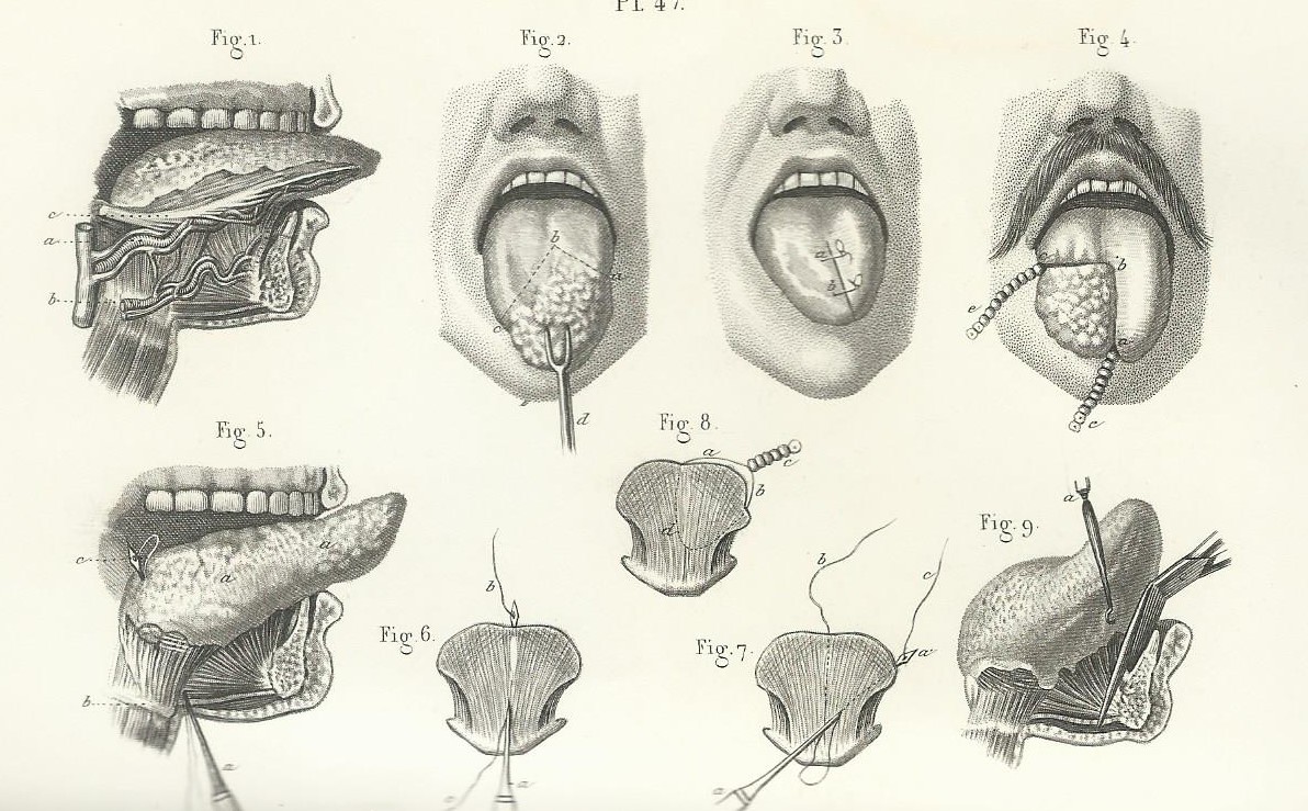 Tratamiento Quir rgico Del C ncer De Lengua En El Siglo XIX Blog De tratamiento-quir-rgico-del-c-ncer-de-lengua-en-el-siglo-xix-blog-de
